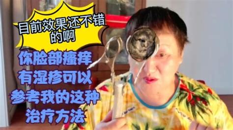 你脸部瘙痒有湿疹可以参考我的这种治疗方法 单桂敏 面部湿疹 艾灸 新浪新闻