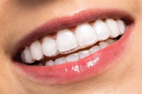 Invisalign Saiba Mais Sobre O Aparelho Transparente Inovador Sem