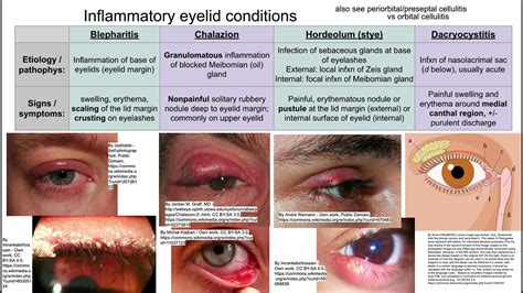 Preseptal Cellulitis Vs Orbital Cellulitis