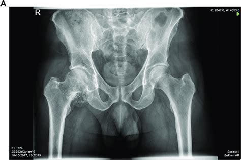 A The Lesion On Conventional Radiography The Anteroposterior