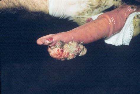 Penis To Vagina Transformation