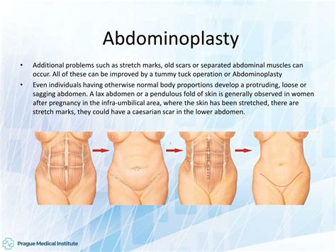 PPT Abdominoplasty Tummy Tuck PowerPoint Presentation Free