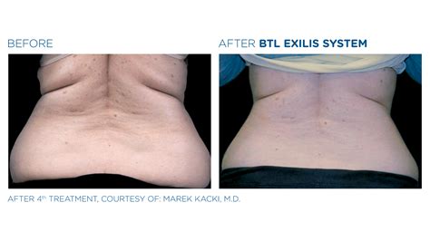 Skin Tightening Treatments In Columbus Ohio With Exilis Ultra