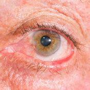 Ptosis Ectropion Entropion Diagnosis Cost Of Treatment In Delhi