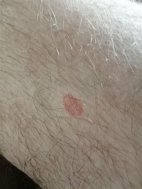 Red Mark On My Leg Been There A Few Weeks Now With No Sign Of Going