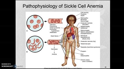 Sickle Cell Crisis Sp16 Youtube