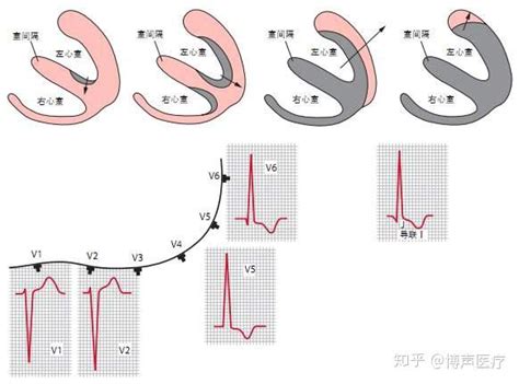 博声医疗左心室肥大左心室肥大的原因 知乎