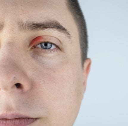 Red Skin around Eyes: Causes, Treatment and Link with Demodex| Ozidex