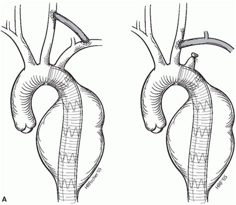 Endovascular Treatment Of Descending Thoracic Aortic Aneurysms Thoracic Key