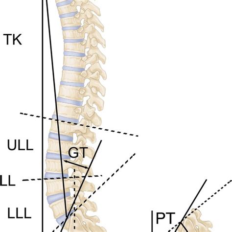 The Descriptions Of Sagittal Parameters Gt Global Tilt Sva Sagittal