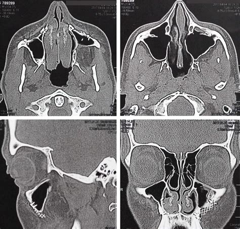 CT Scan Performed One Year After Odontogenic Keratocyst Enucleation