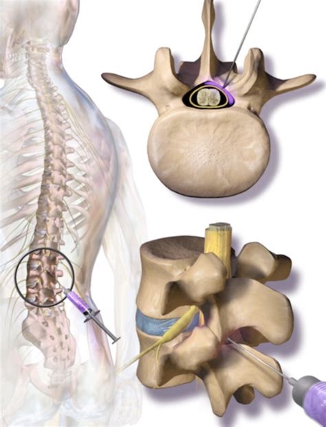 Spine Injections Part 1 - Lumbar Epidural Injections - Rocky Mountain ...