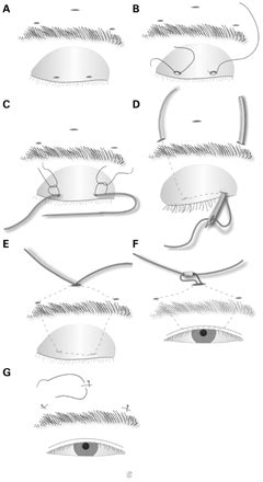 Frontalis Sling Operation Using Silicone Rod For The Correction Of