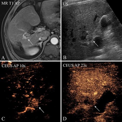 61 Year Old Female With Etoh And Hcv Cirrhosis On Secondary Download Scientific Diagram