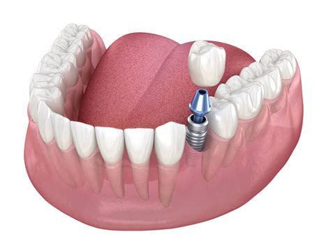 Dental Implants Brisbane Implant Cost And Prices My Site