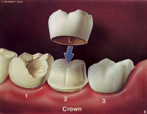 Dental Crowns and Bridges in Sydney - Quality Teeth Caps Treatment | Ryde | Gladesville | North ...