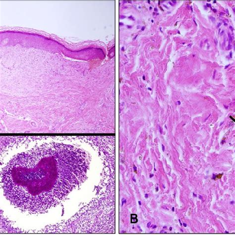 A Skin Biopsy Specimen Showing Hyperkeratosis Pseudoepitheliomatous