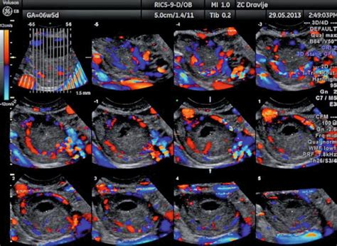 The Normal Ovary Changes In The Menstrual Cycle Radiology Key