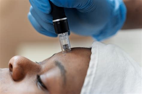 The Guide To Microneedling With Prp Valley Dermatology