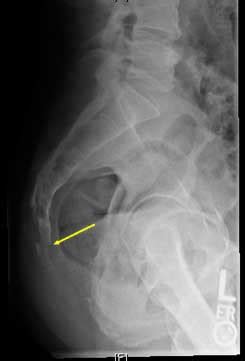 Coccyx Fracture Xray