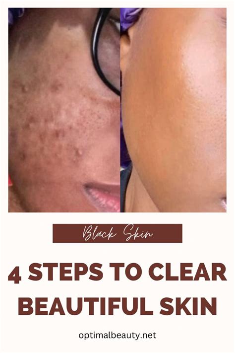 4 Steps To Clear Beautiful Skin Naturally Optimal Beauty