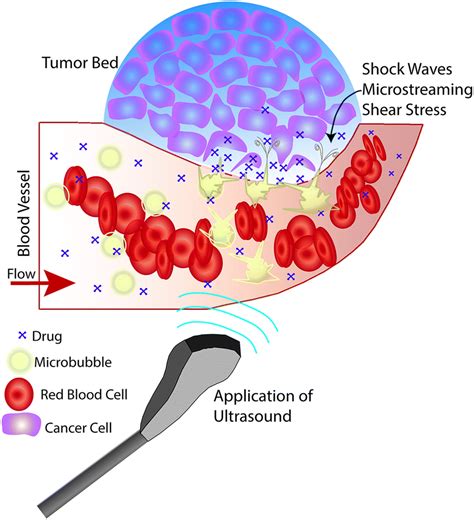 Making Waves How Ultrasound Targeted Drug Delivery Is Changing