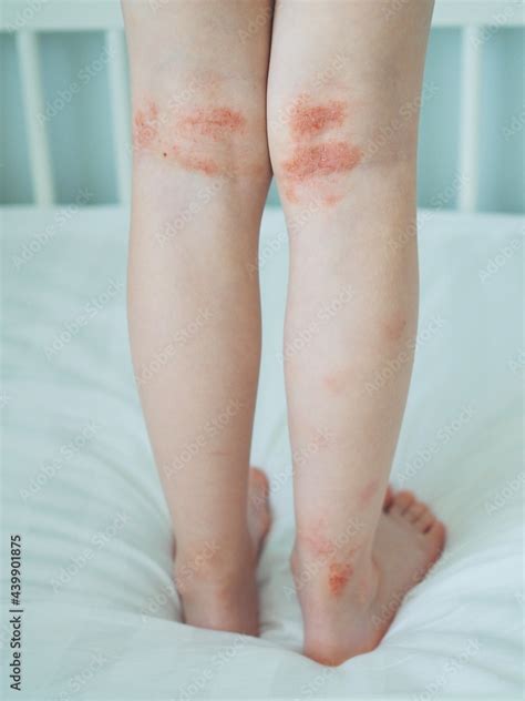 Eczema On Kid S Legs Atopic Dermatitis Close Up Allergy Spots And Red