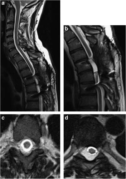 Sagittal T2 Weighted Fast Spin Echo Fse 6 Months Following Cordectomy