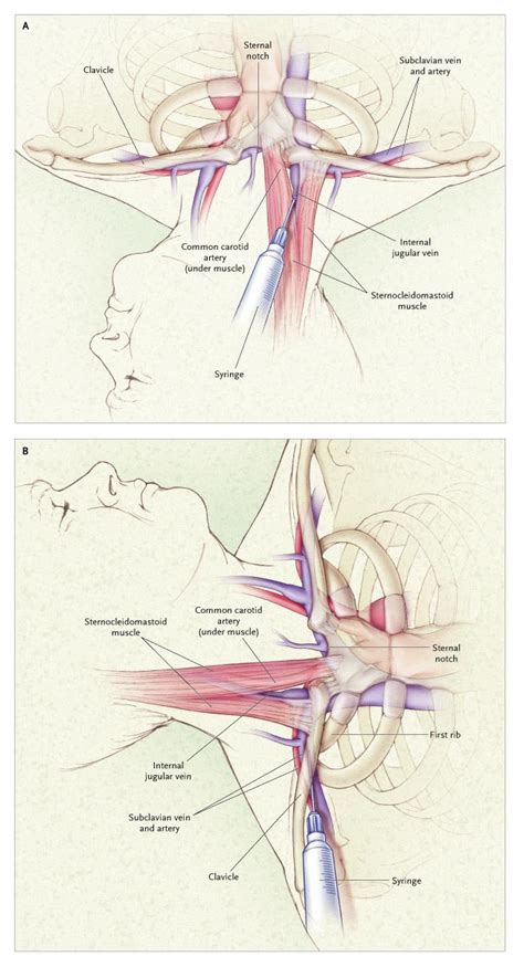 Internal Jugular Central Venous Catheter