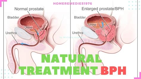 The Best Natural Cures For Prostate Enlargement Or Bph Youtube