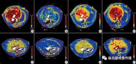 Gd Eob Dtpa动态对比增强mri定量评估大鼠中度肝纤维化价值的研究诊断成像磁共振