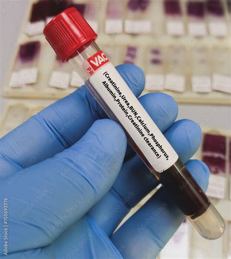 Blood Sample For Renal Function Test Creatinine Bun Egfr Albumin