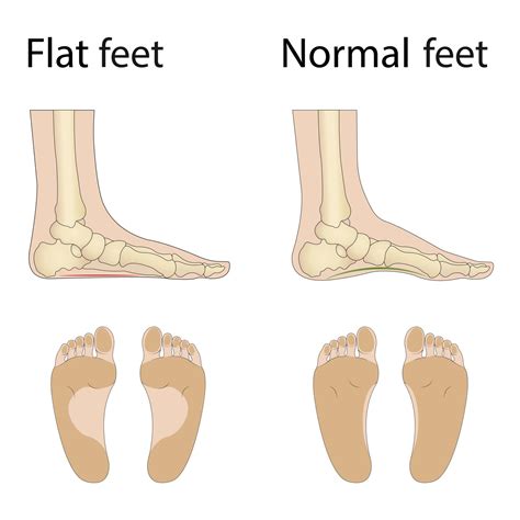 Tipi Di Deformit Del Piede Infografica Sulle Malattie Mediche Piede