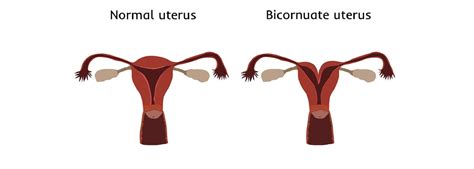 Bicornuate Uterus Double Uterus Symptoms Treatment 58 OFF