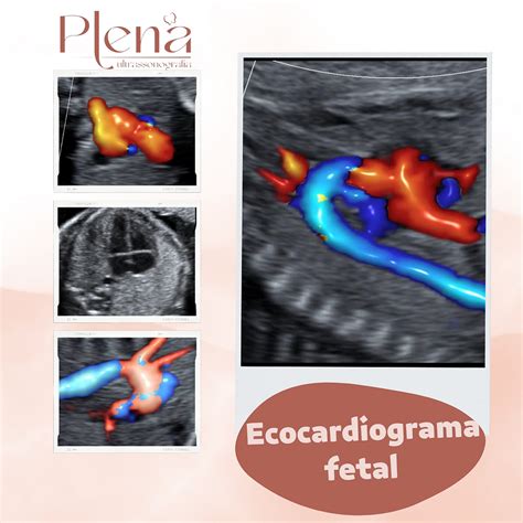 Ultrassom Obstétrico Clínica Plena Ultrassonografia Niterói Rj Brasil