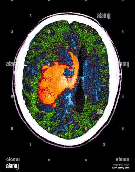 Hemorragia Intraparenchymal Iph Un Color De Tomografía Computarizada