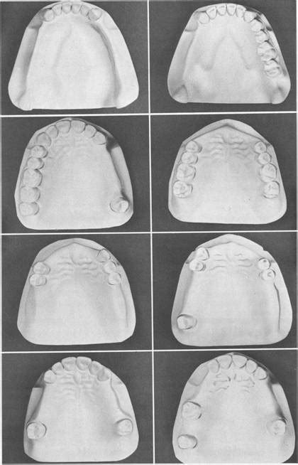 Classification Of Partially Edentulous Arches