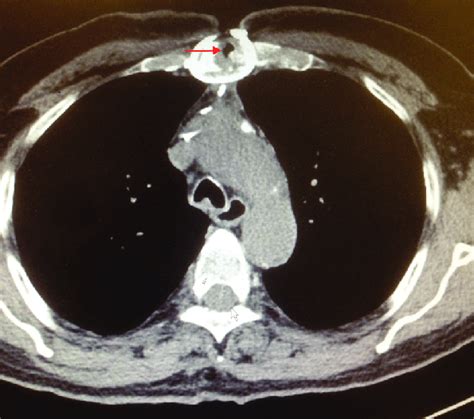 Computed Tomography Of The Chest Shows Osteomyelitis Of The Sternum