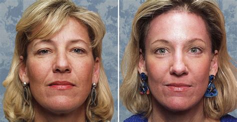 Endoscopic Brow Lift Forehead Lift Surgery Plastic Surgeon Dallas