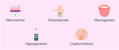 Clinical manifestations of Beckwith Wiedemann syndrome