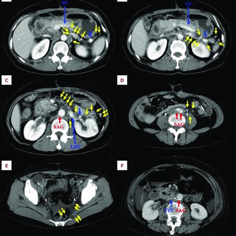 Arterial reconstruction using synthetic arterial graft. (A) An I-shaped ...