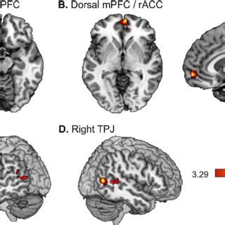 Increased precuneus and right temporoparietal junction activation in ...