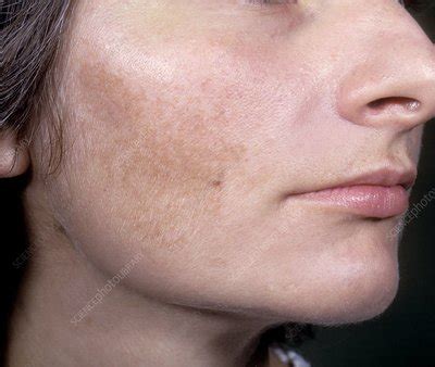 Melasma Chloasma On The Face Stock Image C Science