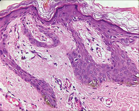 Generalized Dowling–Degos disease with hypopigmented lesions: A ...