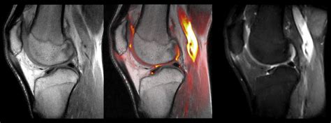 Patellar Tendon MRI