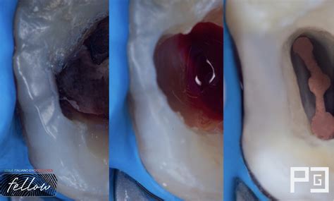Management of an upper second molar with a restorative approach - Style