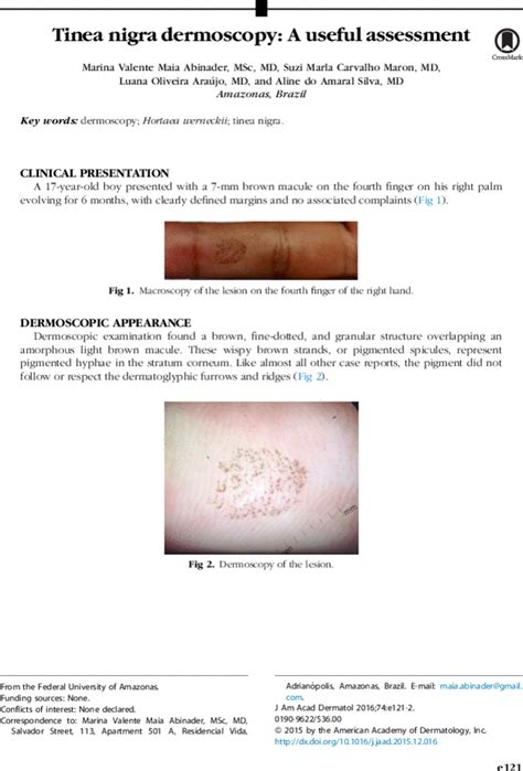 Tinea Nigra Dermoscopy A Useful Assessment Journal Of The American Academy Of Dermatology