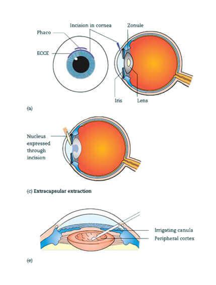 Cataract Surgery In Iran Procedure Results Cost MITRAMED