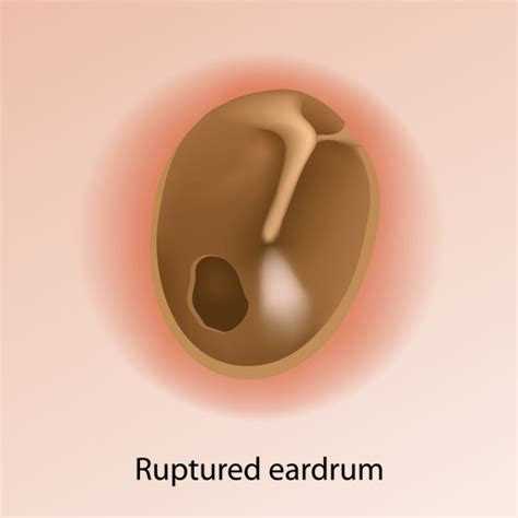 Tympanic Membrane Perforation | ENT Kerimis Clinic Ears,Nose, and Throat in Limassol Cyprus