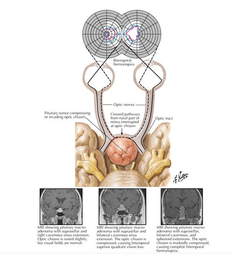 Pituitary Tumor Optic Chiasm